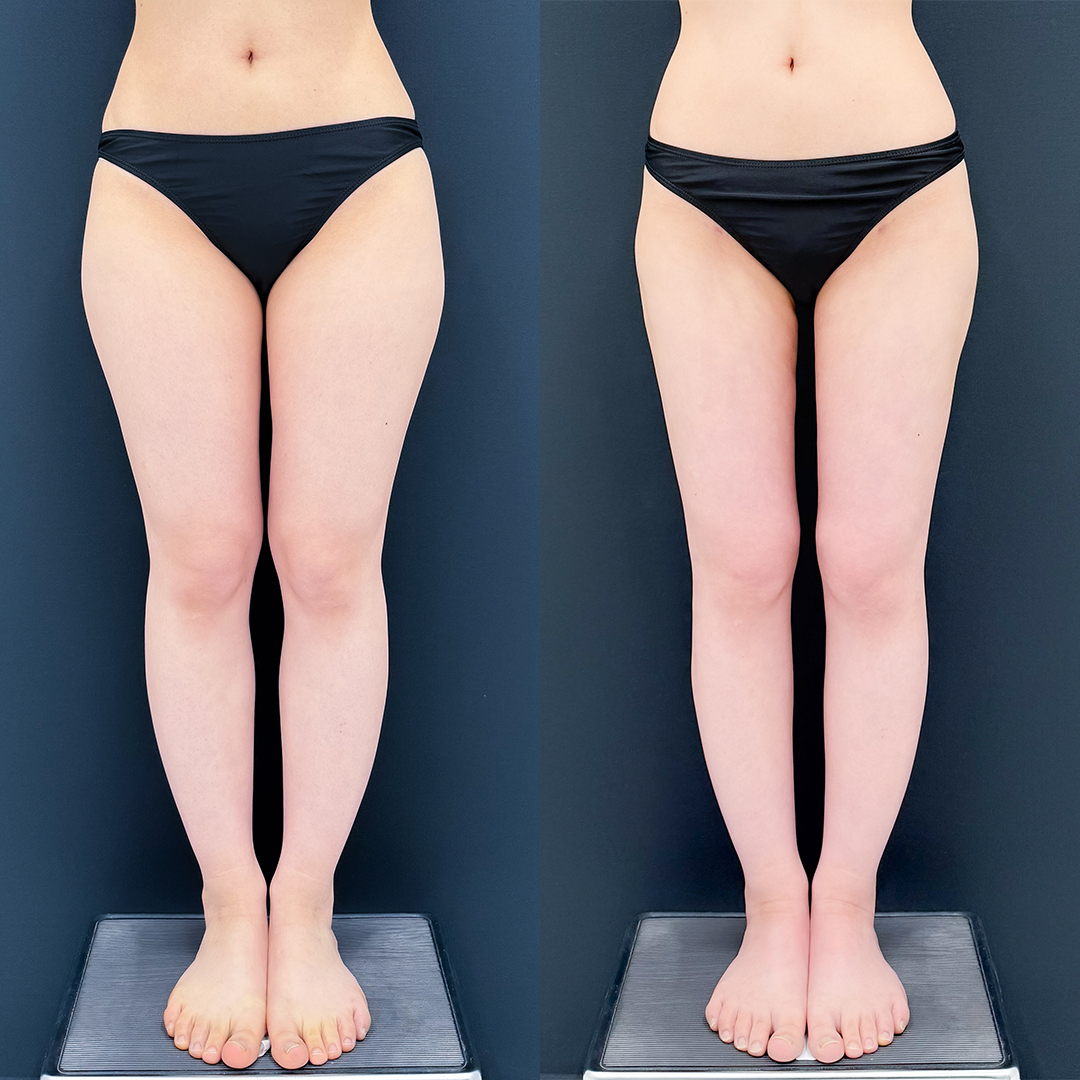 https://purelys-tokyo-clinic.com/wp/wp-content/uploads/2026/06/breast-augmentation_Case-No.283.jpg