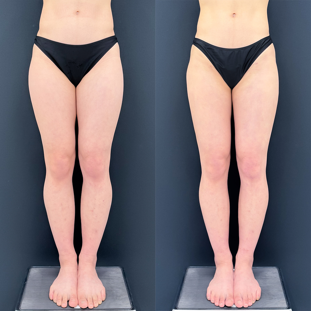 https://purelys-tokyo-clinic.com/wp/wp-content/uploads/2026/06/breast-augmentation_Case-No.284.jpg