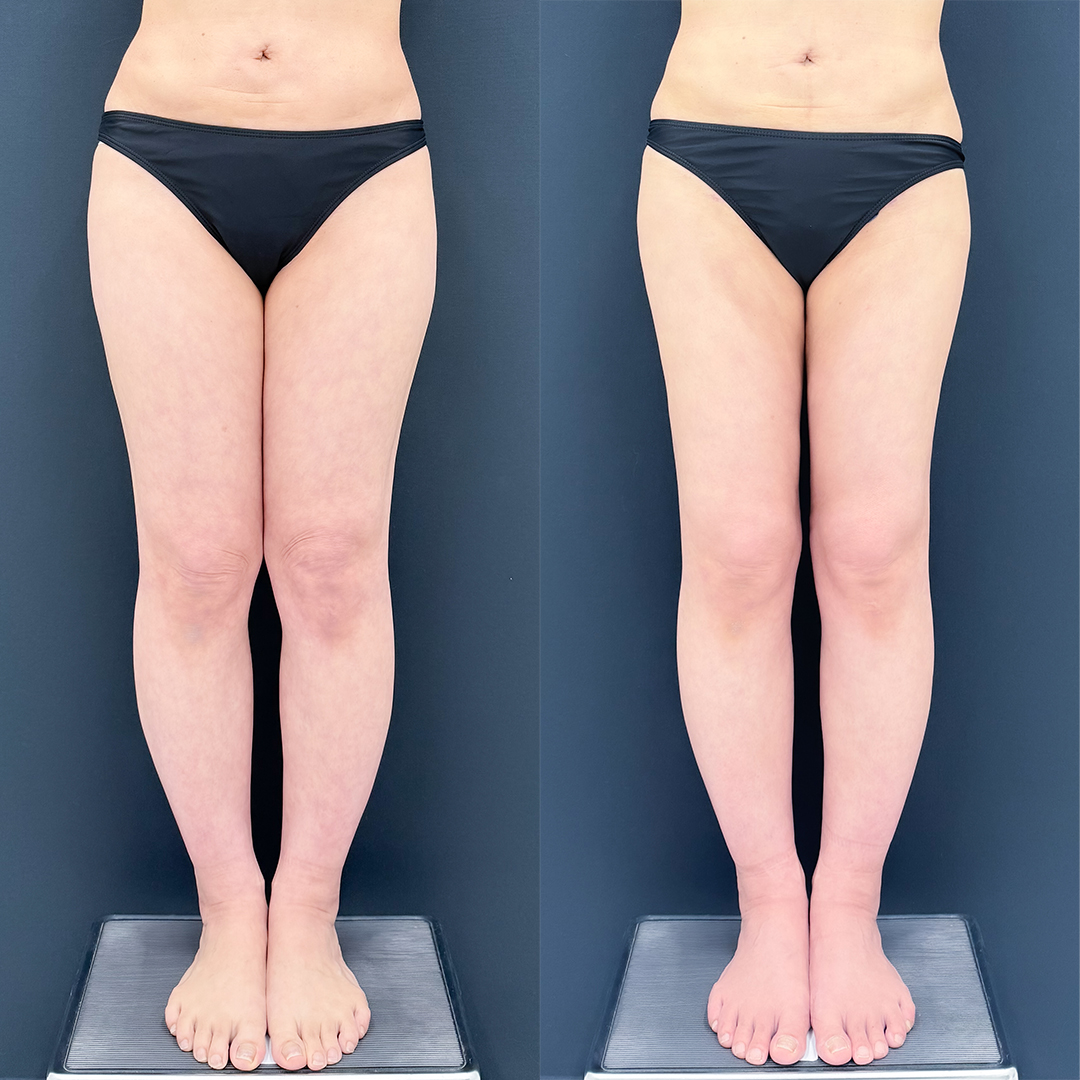 https://purelys-tokyo-clinic.com/wp/wp-content/uploads/2026/06/breast-augmentation_Case-No.286.jpg