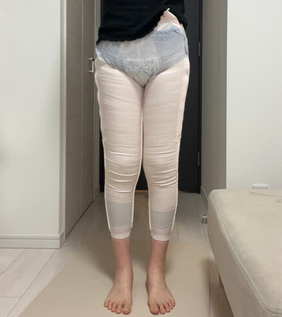 脂肪豊胸
