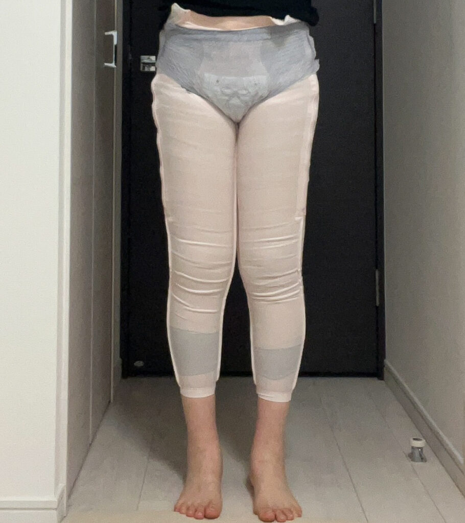 脂肪豊胸