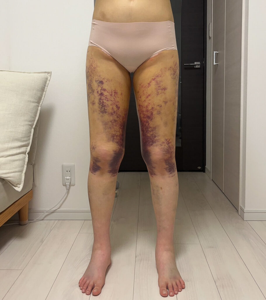 脂肪豊胸
