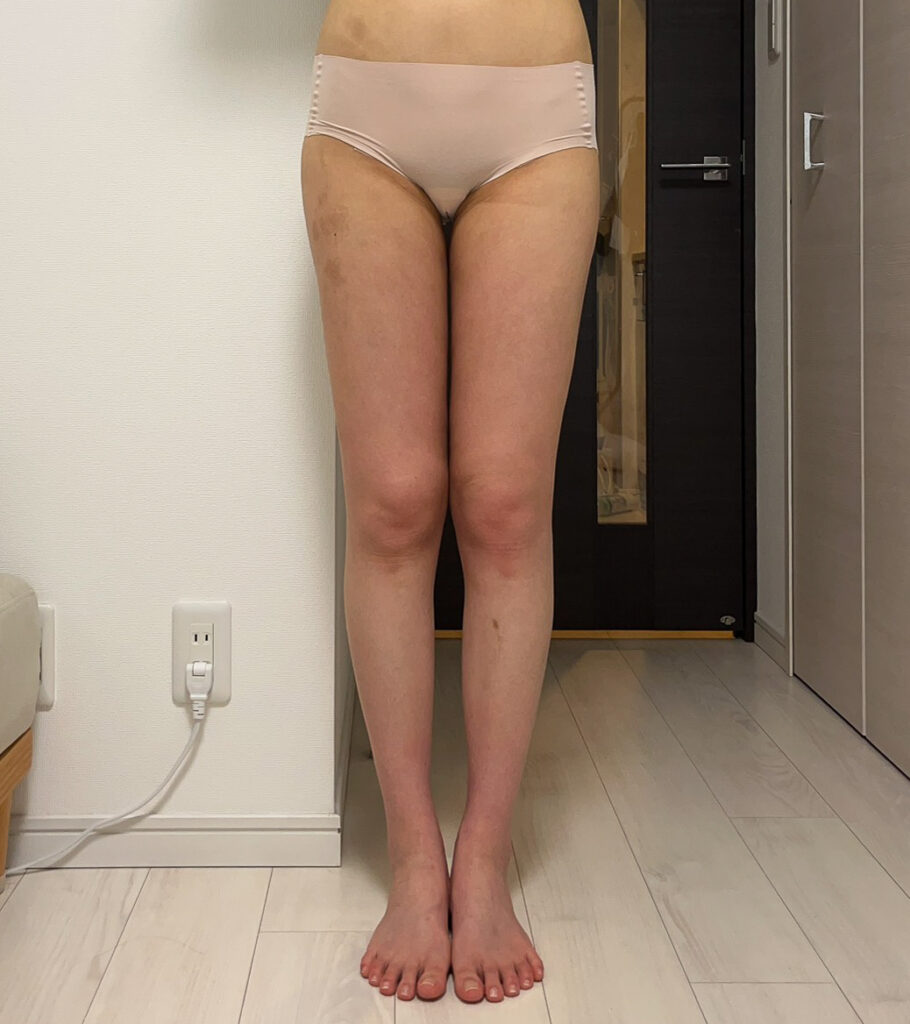 脂肪豊胸