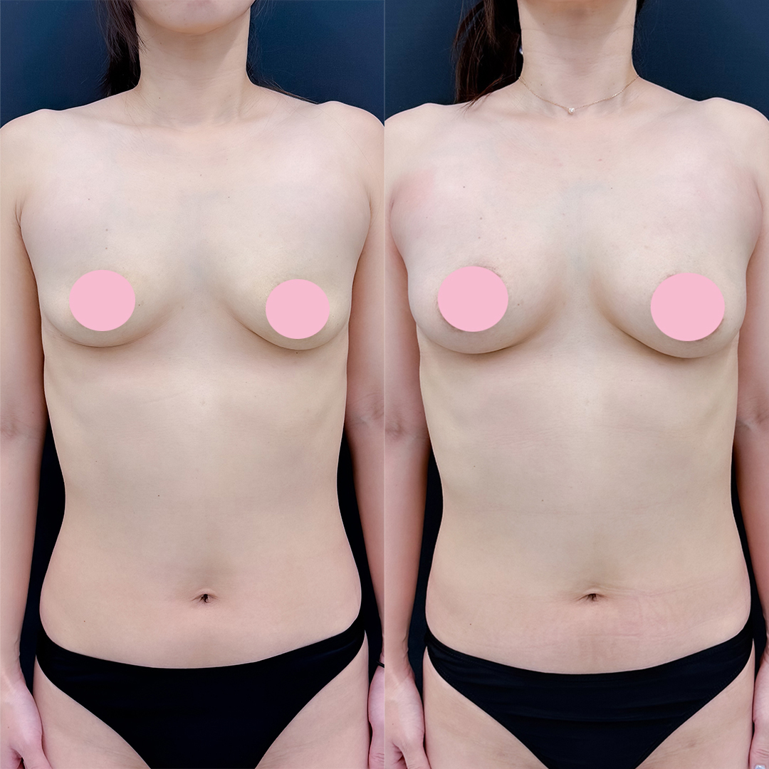 https://purelys-tokyo-clinic.com/wp/wp-content/uploads/2026/06/breast-augmentation_Case-No.332.jpg