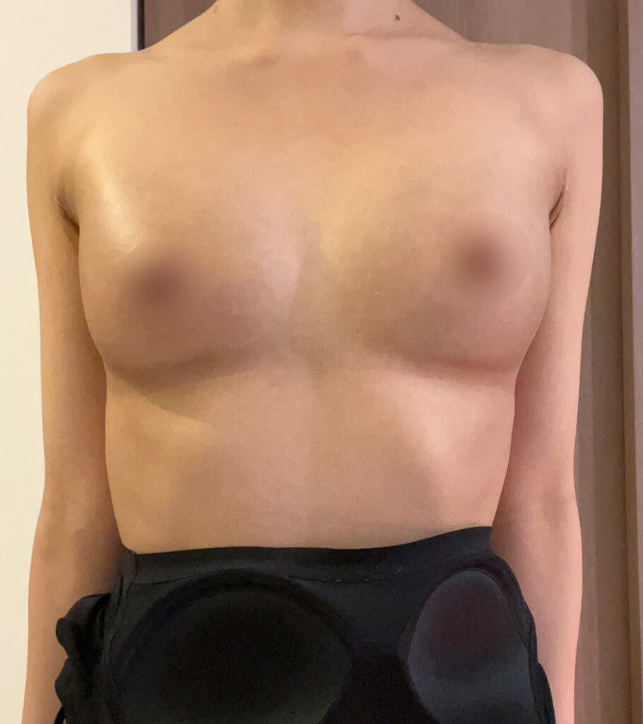 脂肪豊胸