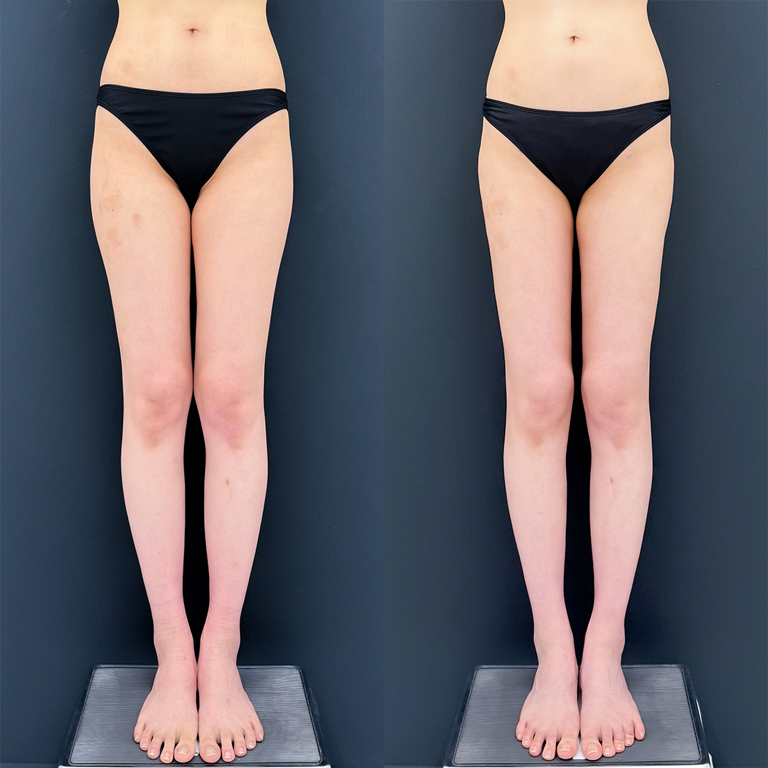 https://purelys-tokyo-clinic.com/wp/wp-content/uploads/2026/06/breast-augmentation_Case-No.349.jpg