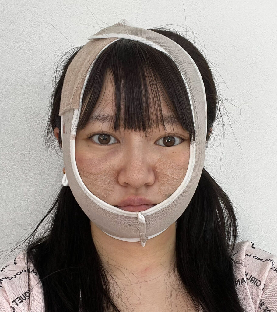 顔の脂肪吸引