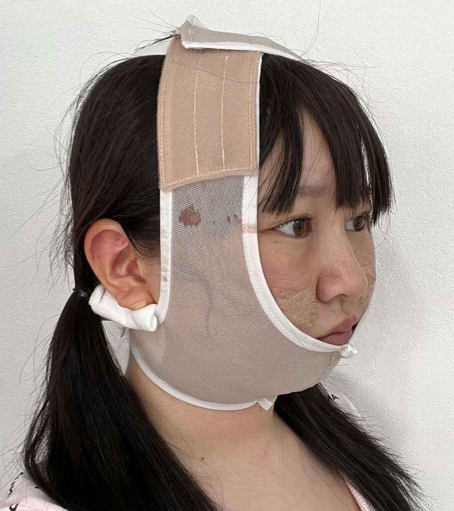 顔の脂肪吸引