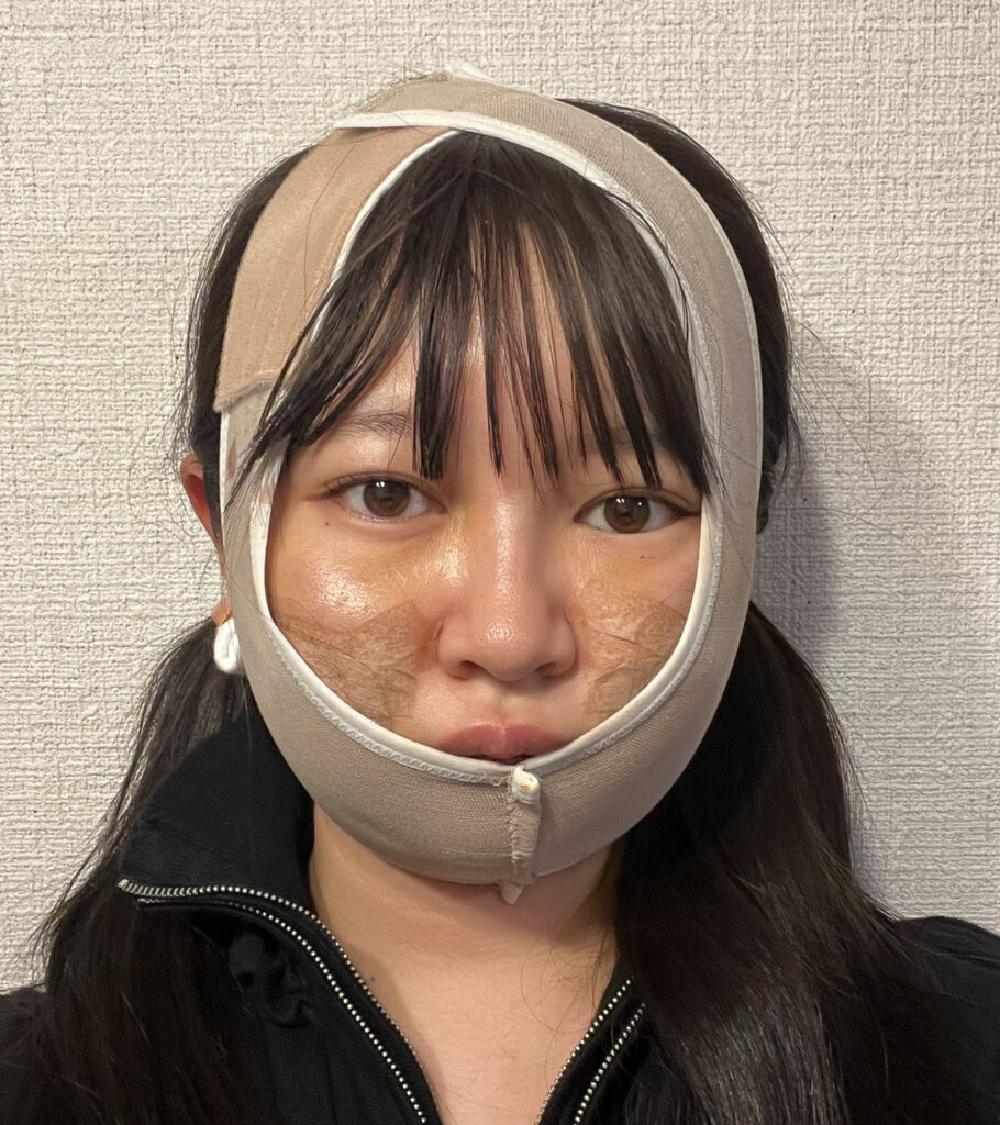 顔の脂肪吸引