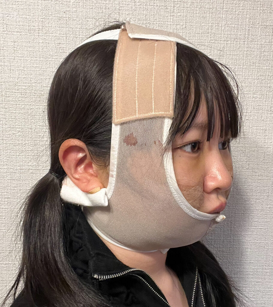 顔の脂肪吸引