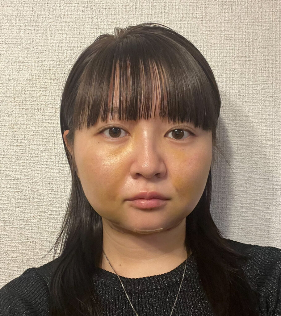 顔の脂肪吸引