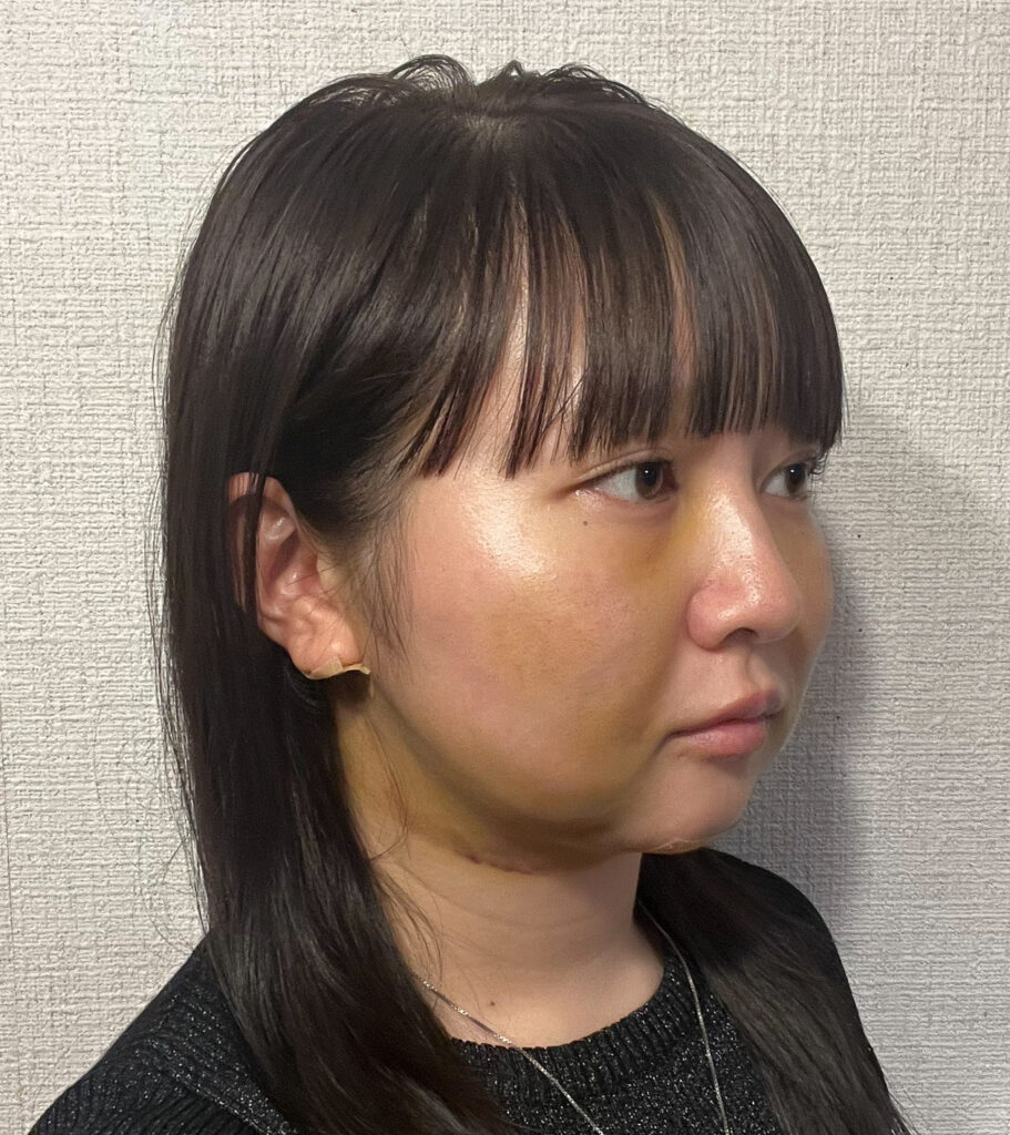 顔の脂肪吸引