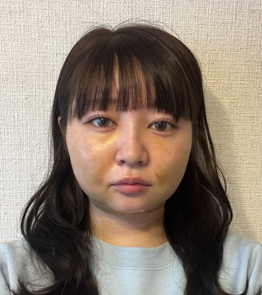 顔の脂肪吸引
