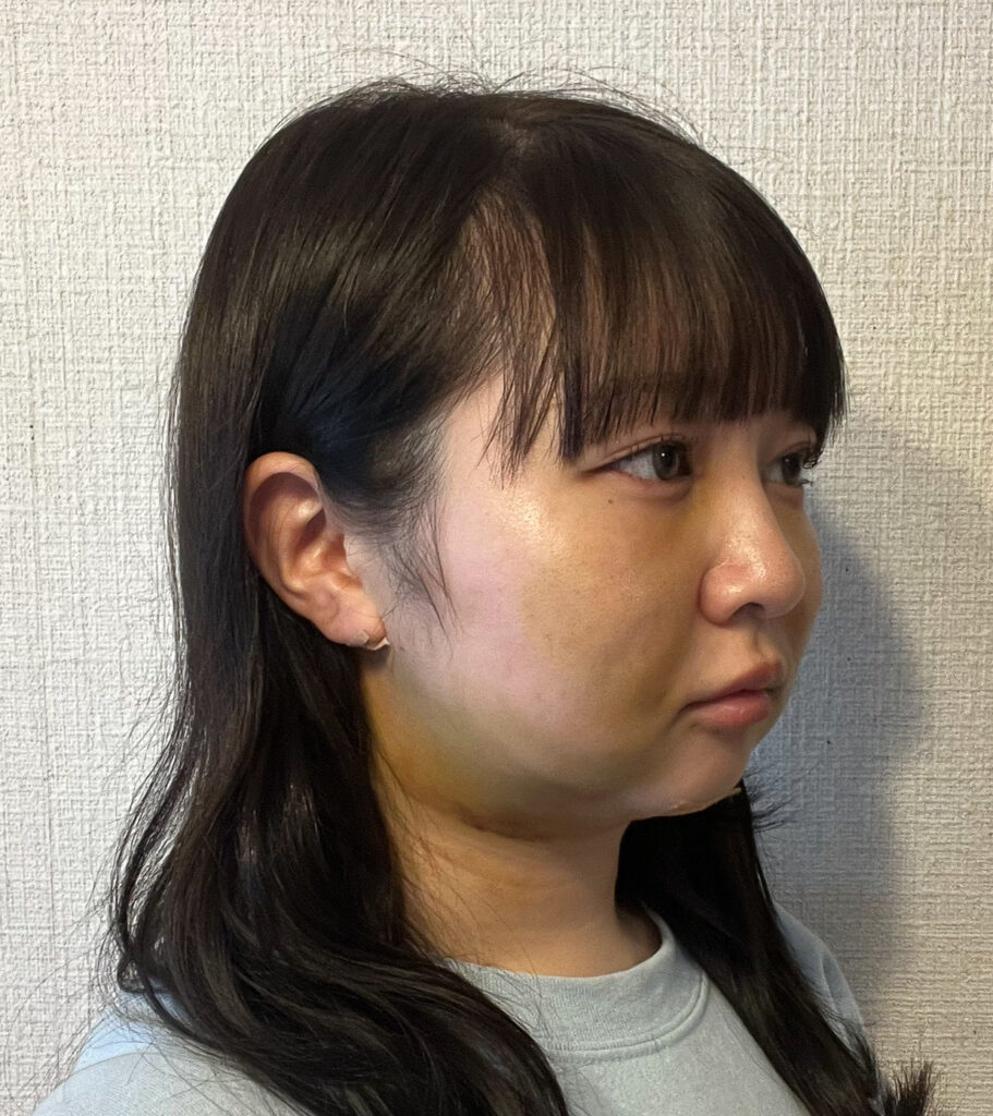 顔の脂肪吸引