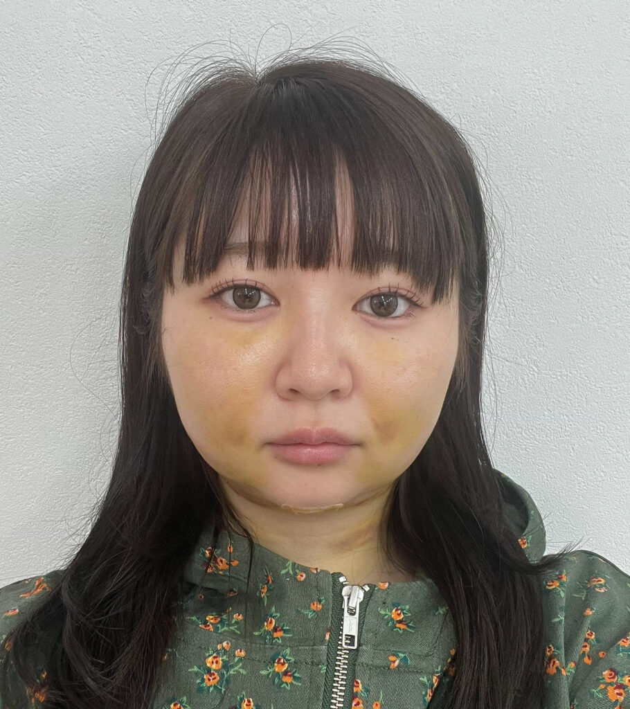 顔の脂肪吸引
