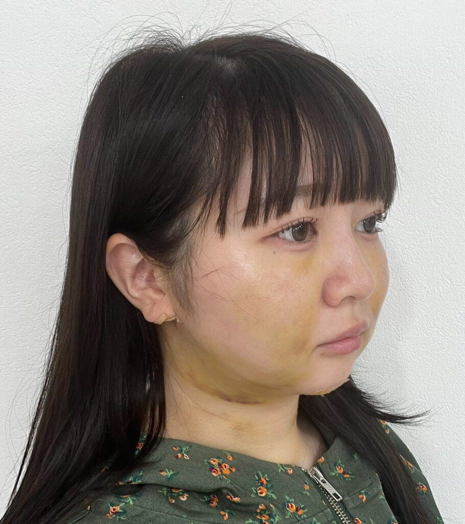 顔の脂肪吸引
