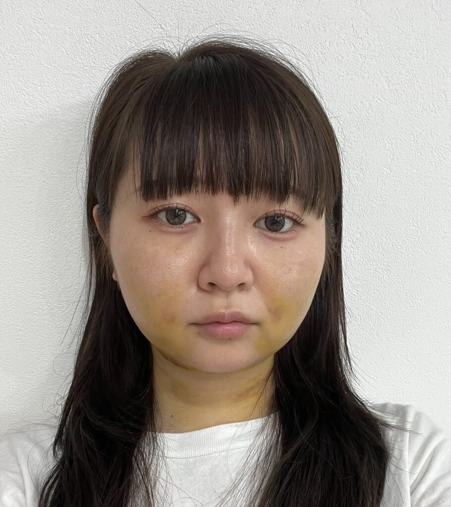 顔の脂肪吸引