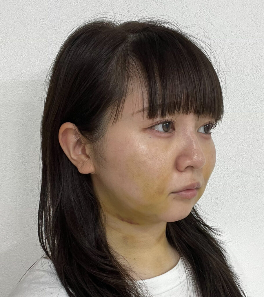 顔の脂肪吸引
