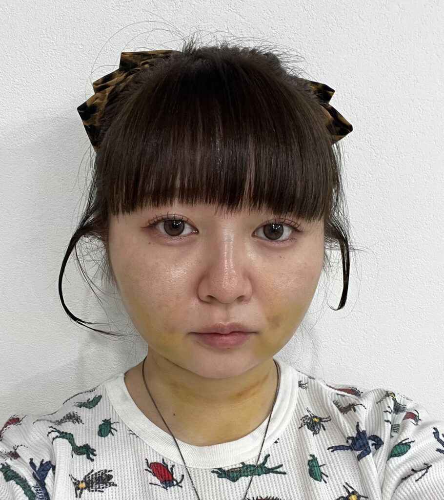 顔の脂肪吸引