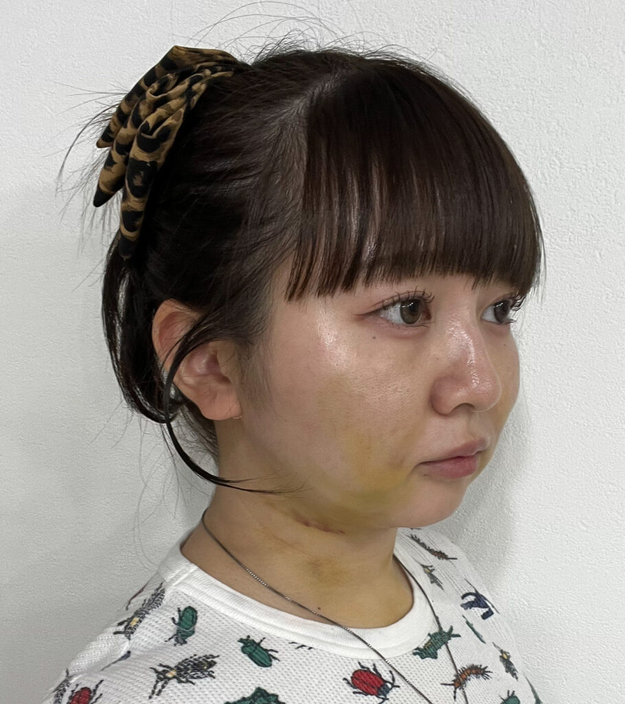 顔の脂肪吸引