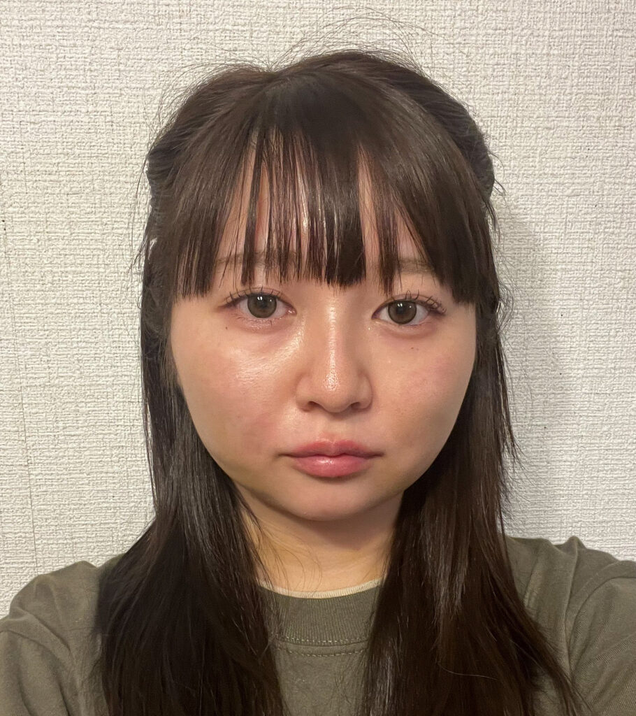 顔の脂肪吸引