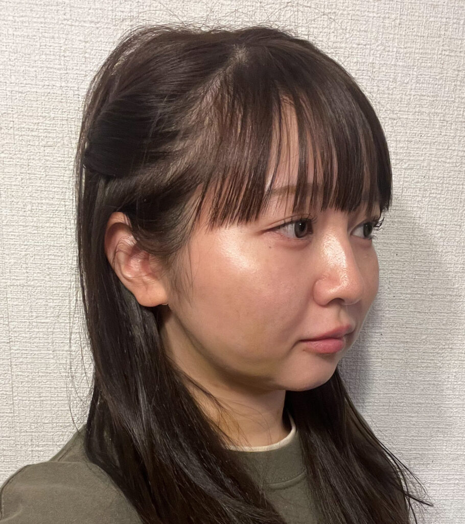 顔の脂肪吸引
