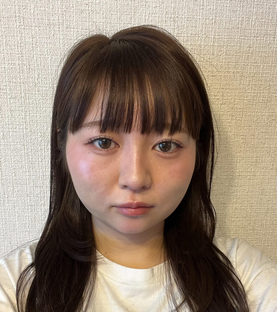顔の脂肪吸引