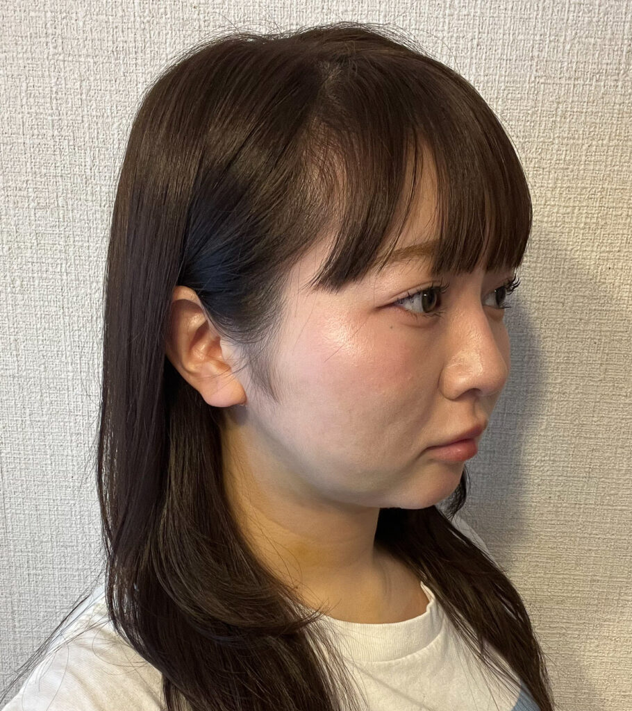 顔の脂肪吸引