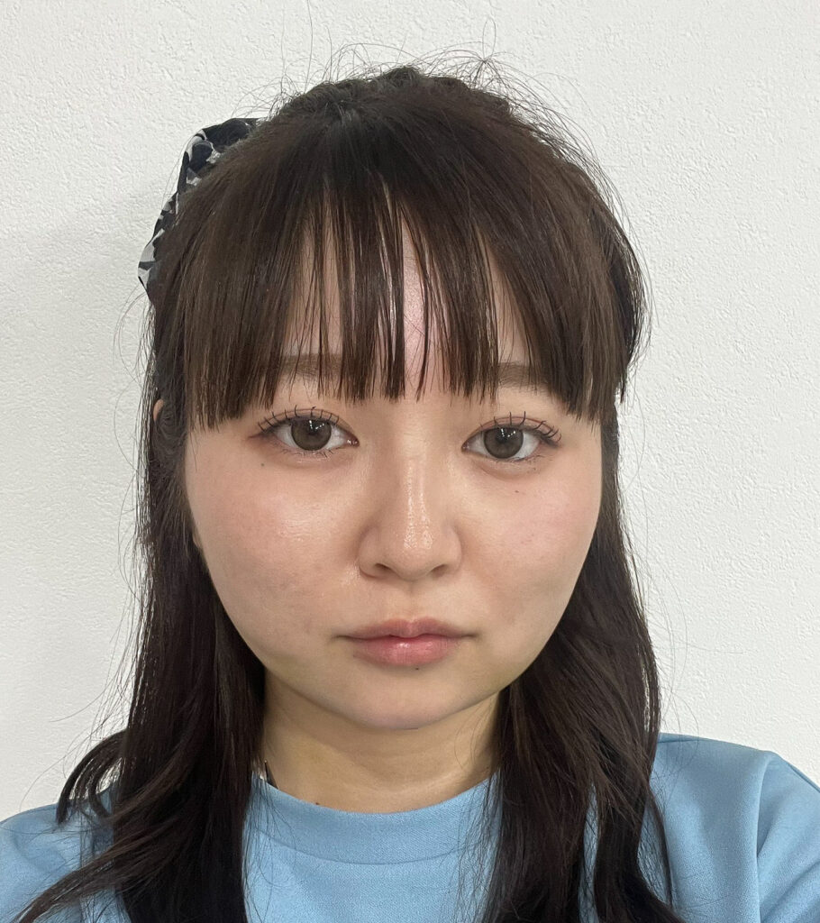 顔の脂肪吸引