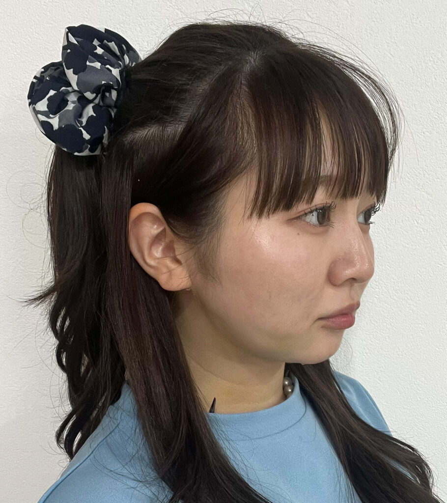 顔の脂肪吸引