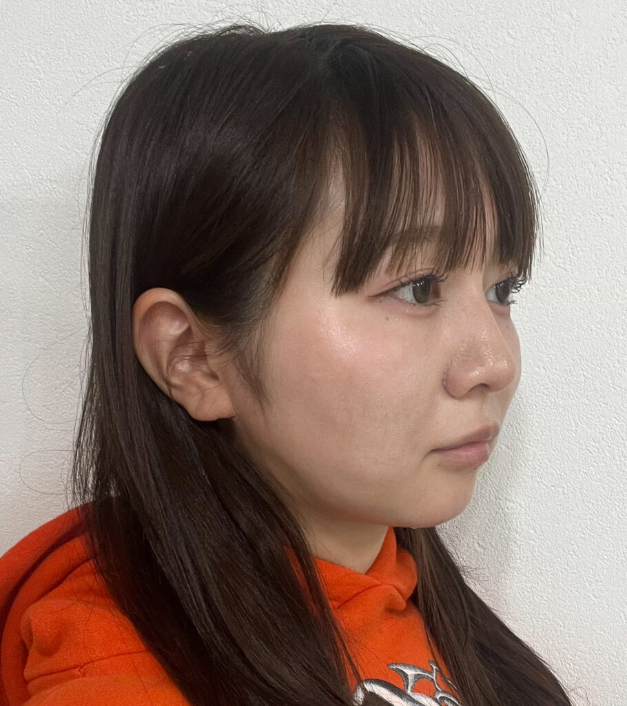 顔の脂肪吸引