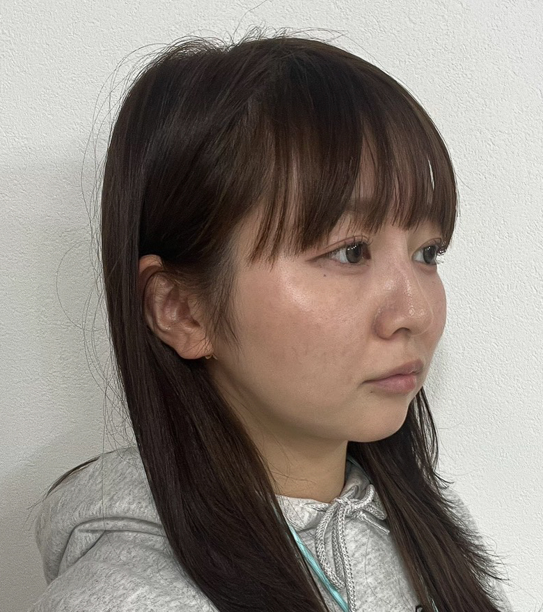顔の脂肪吸引