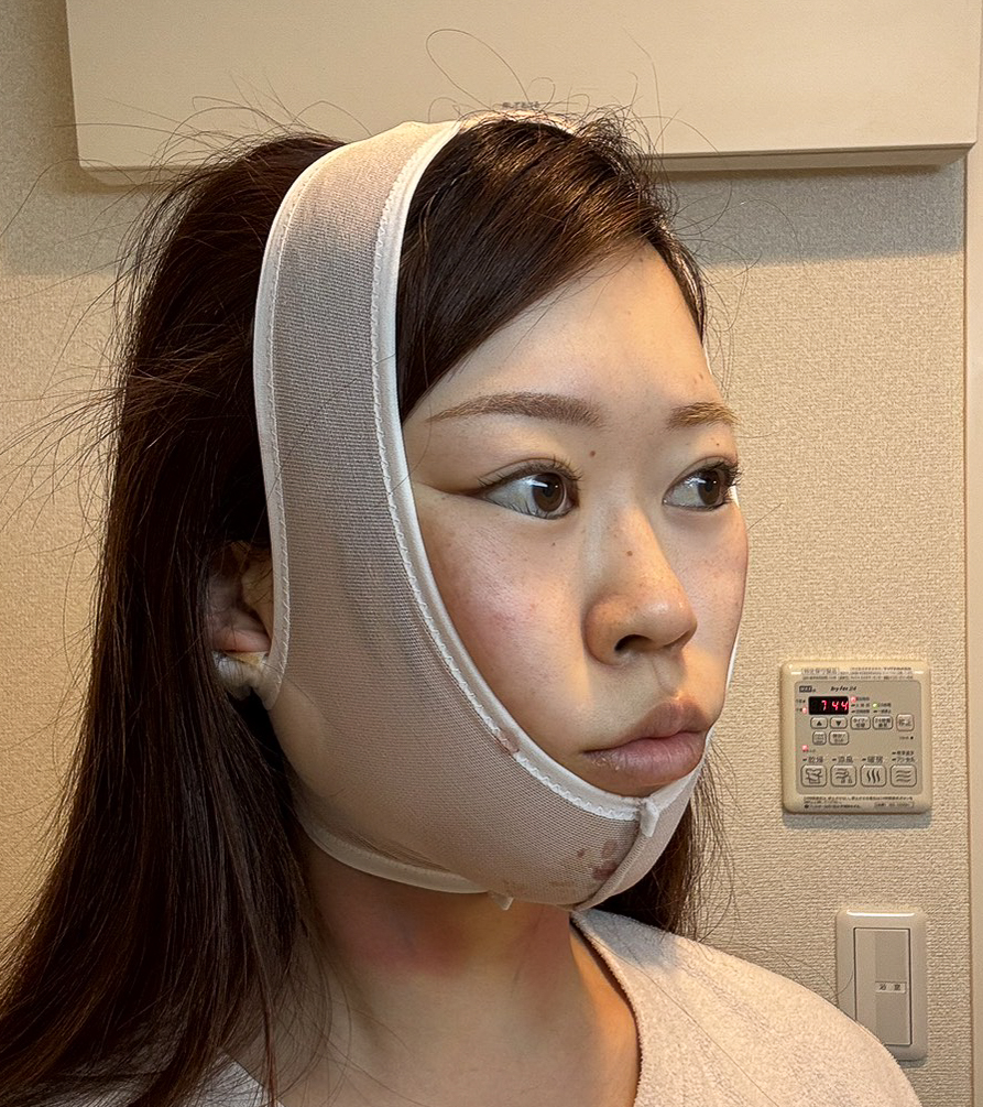 顔の脂肪吸引