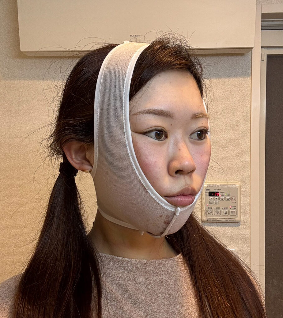 顔の脂肪吸引