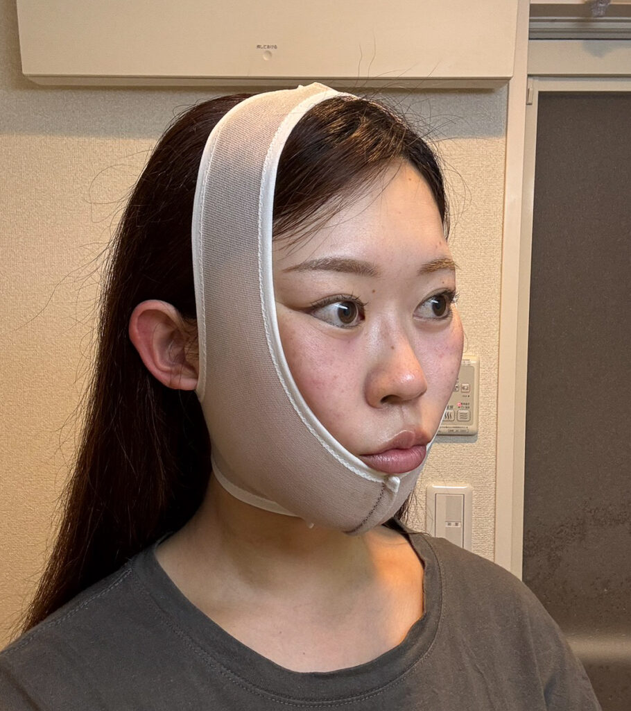 顔の脂肪吸引