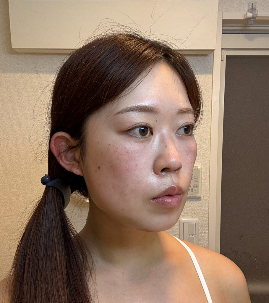顔の脂肪吸引