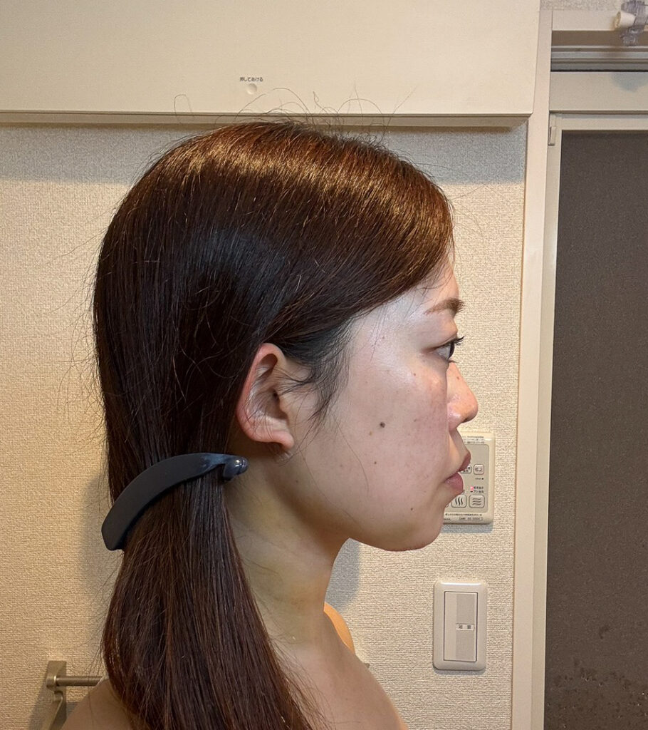 顔の脂肪吸引