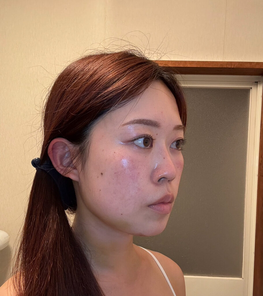 顔の脂肪吸引