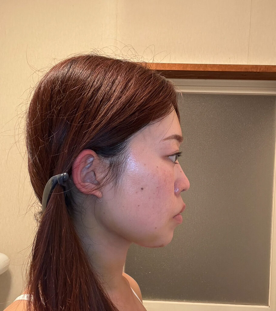 顔の脂肪吸引