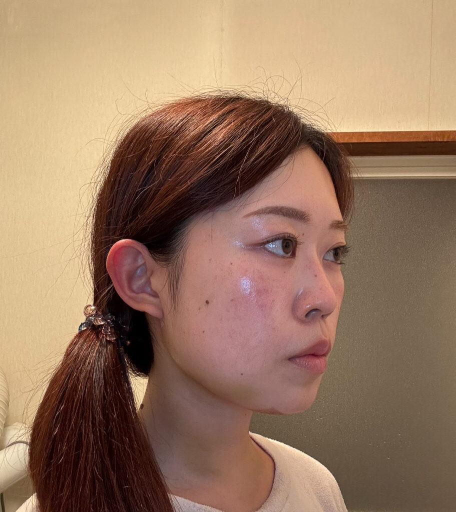 顔の脂肪吸引