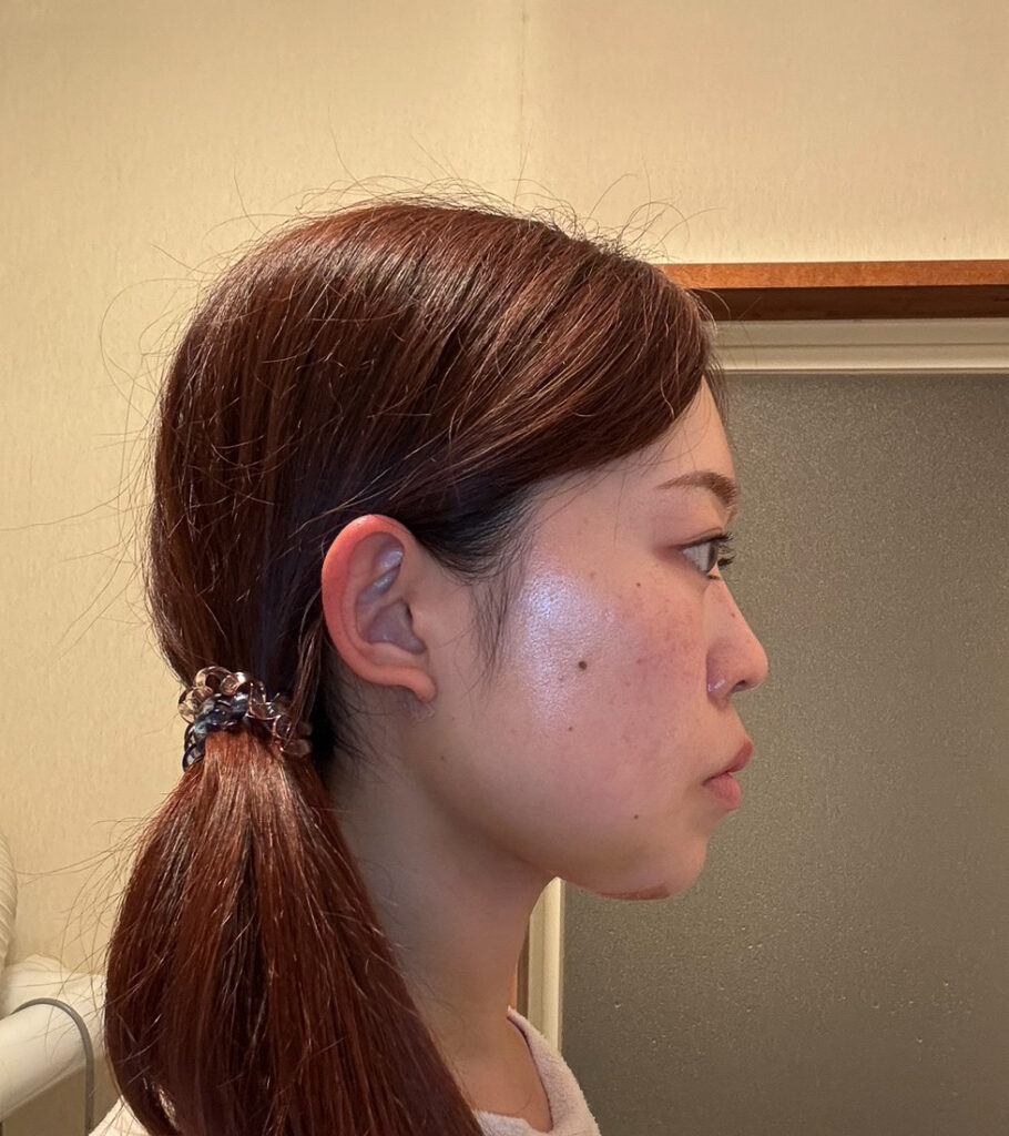顔の脂肪吸引