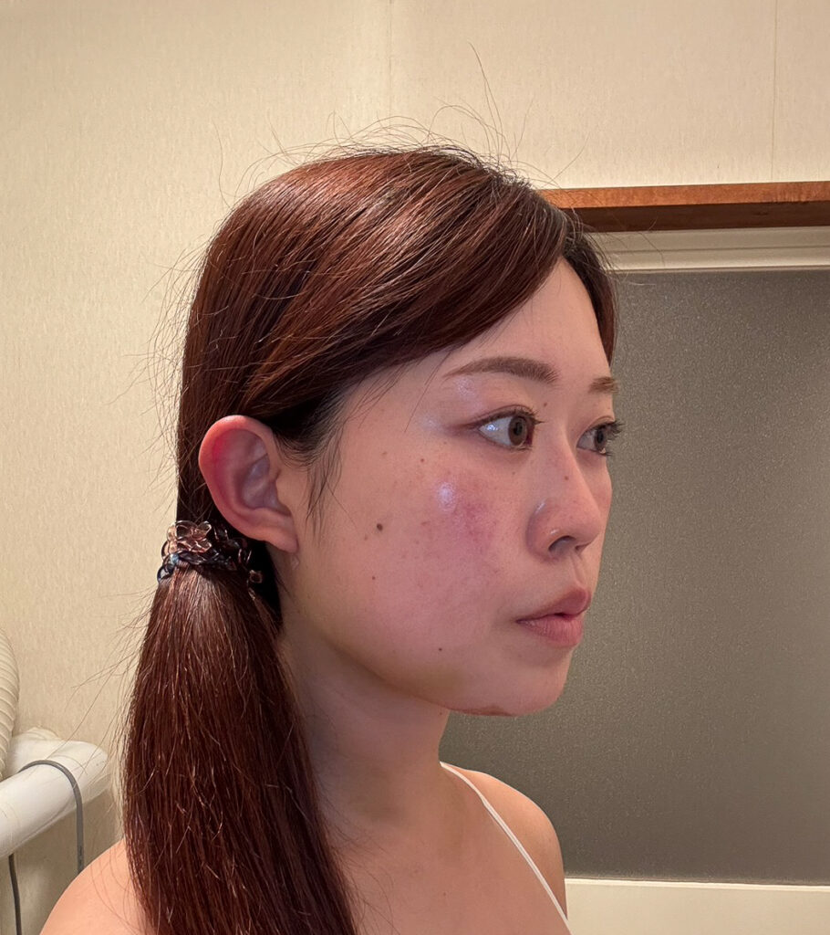 顔の脂肪吸引