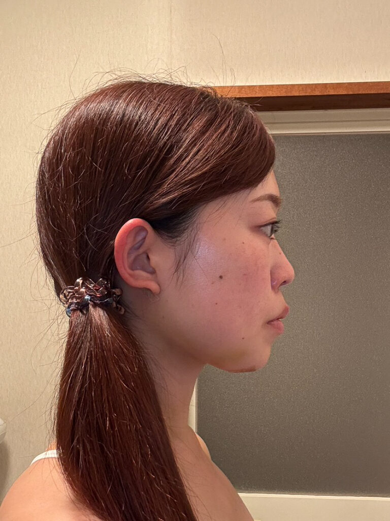 顔の脂肪吸引