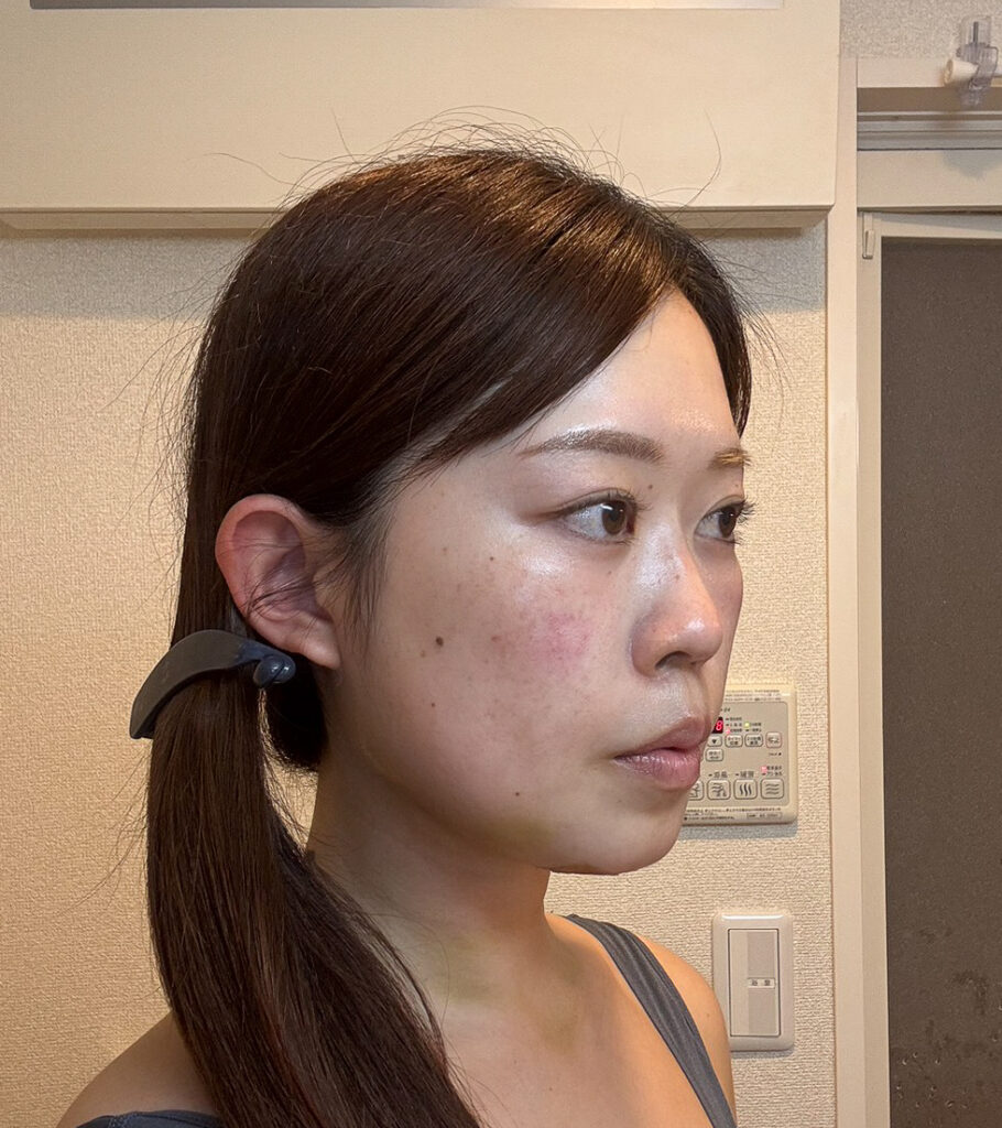 顔の脂肪吸引