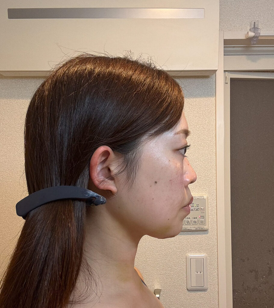 顔の脂肪吸引