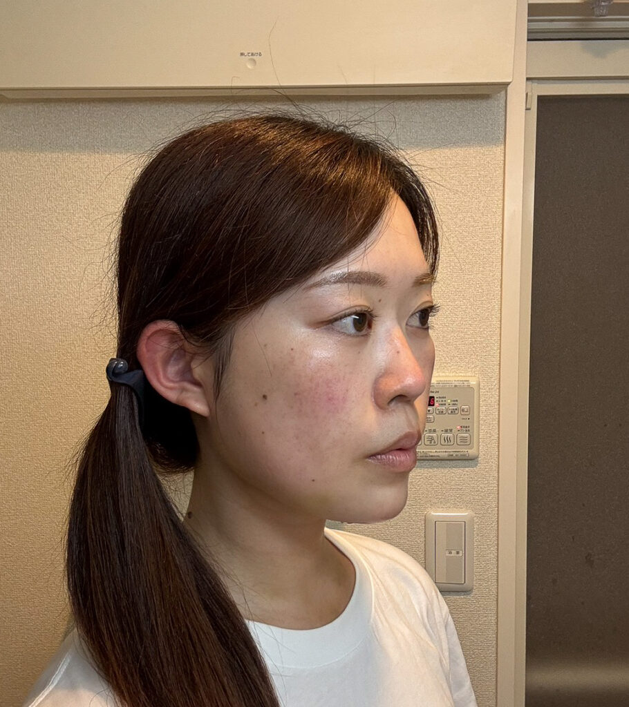 顔の脂肪吸引