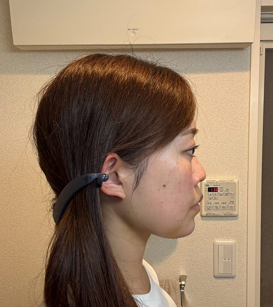 顔の脂肪吸引