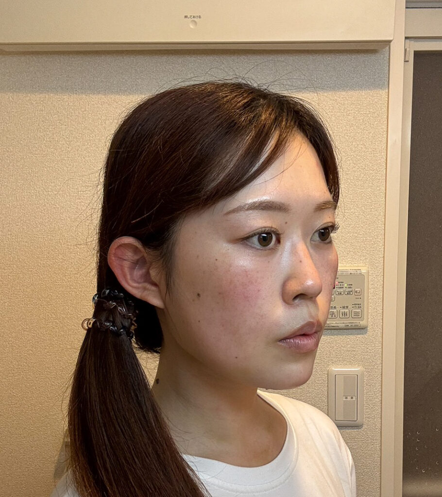 顔の脂肪吸引