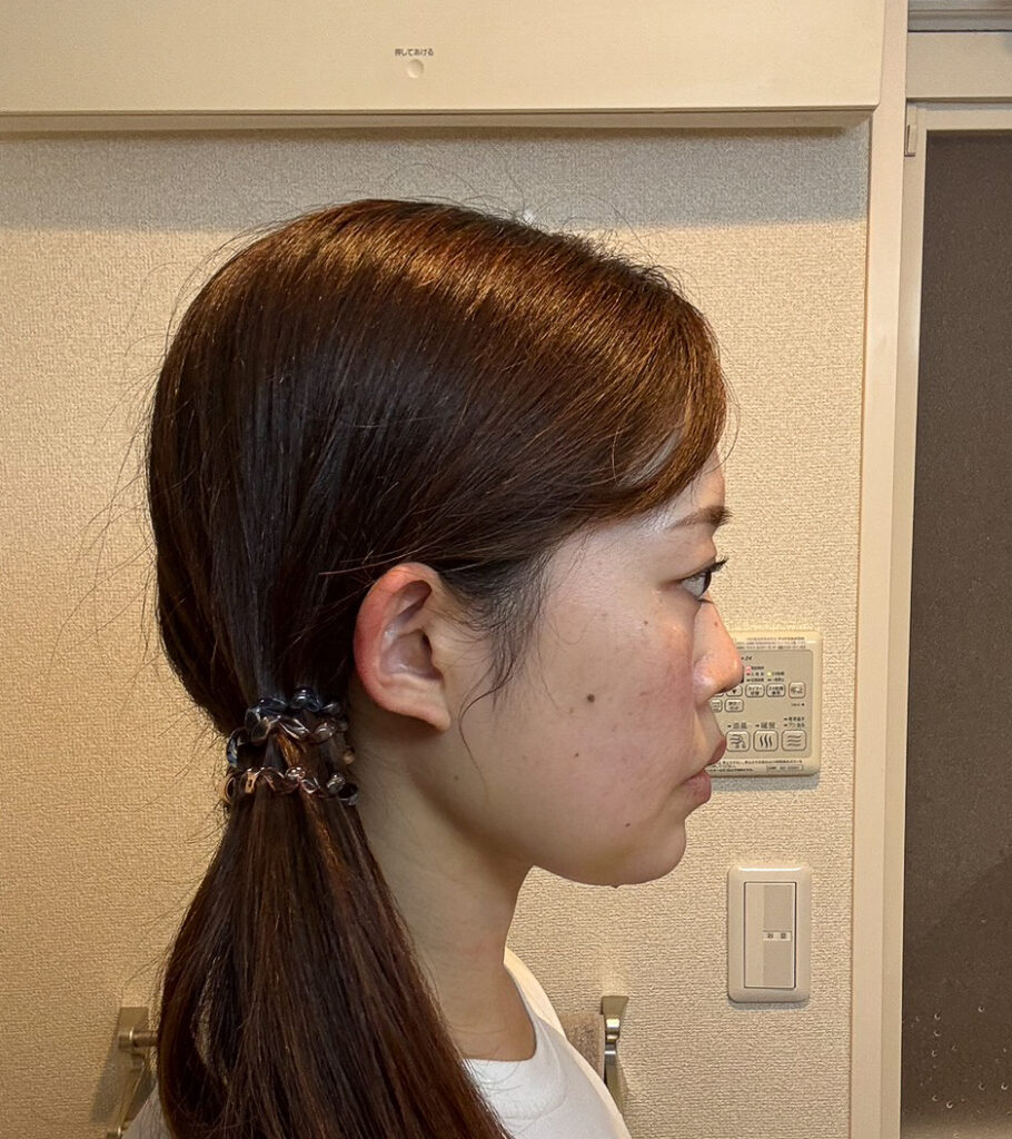 顔の脂肪吸引
