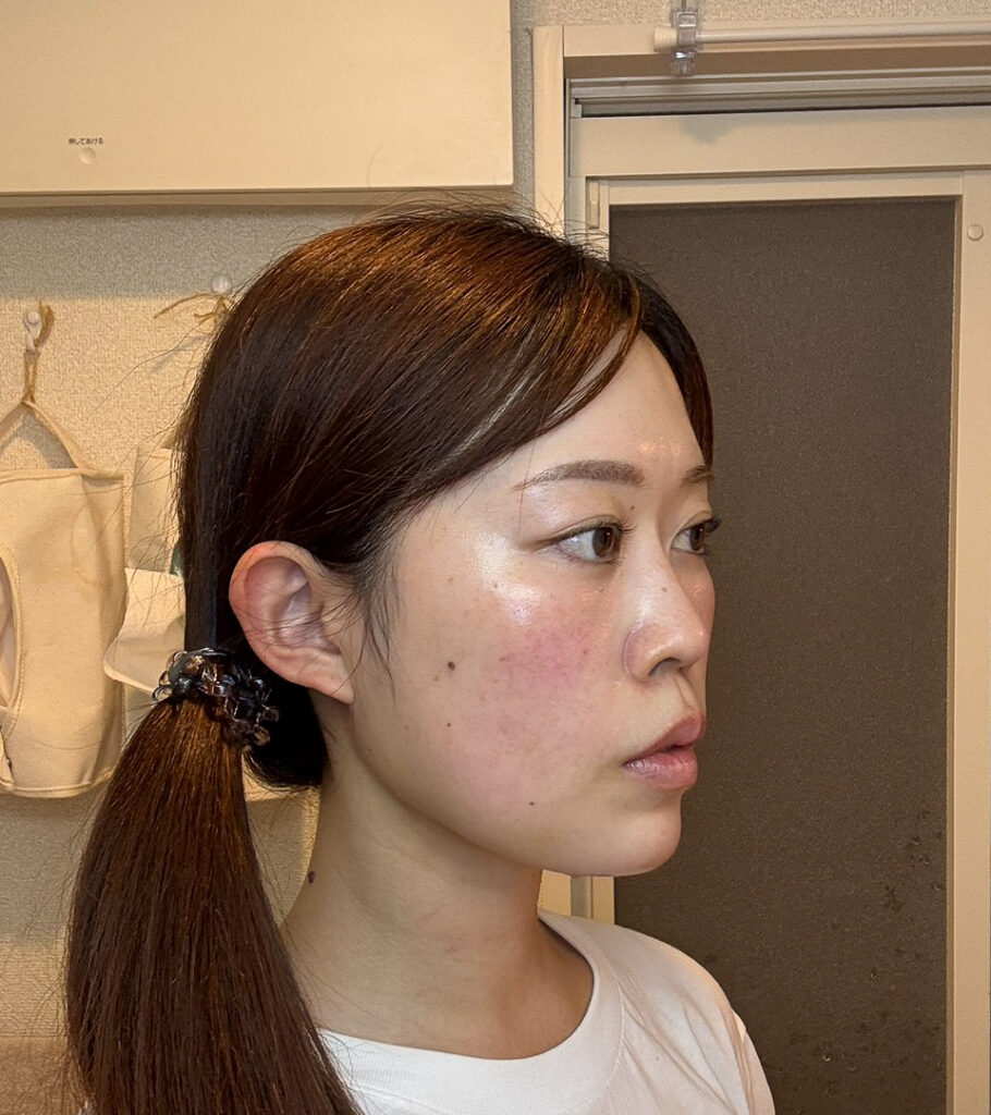 顔の脂肪吸引
